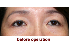 plastic-surgery-blepharoplasty